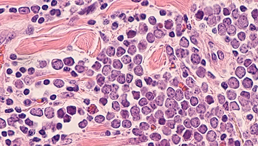 merkel cell carcinoma cells vsm